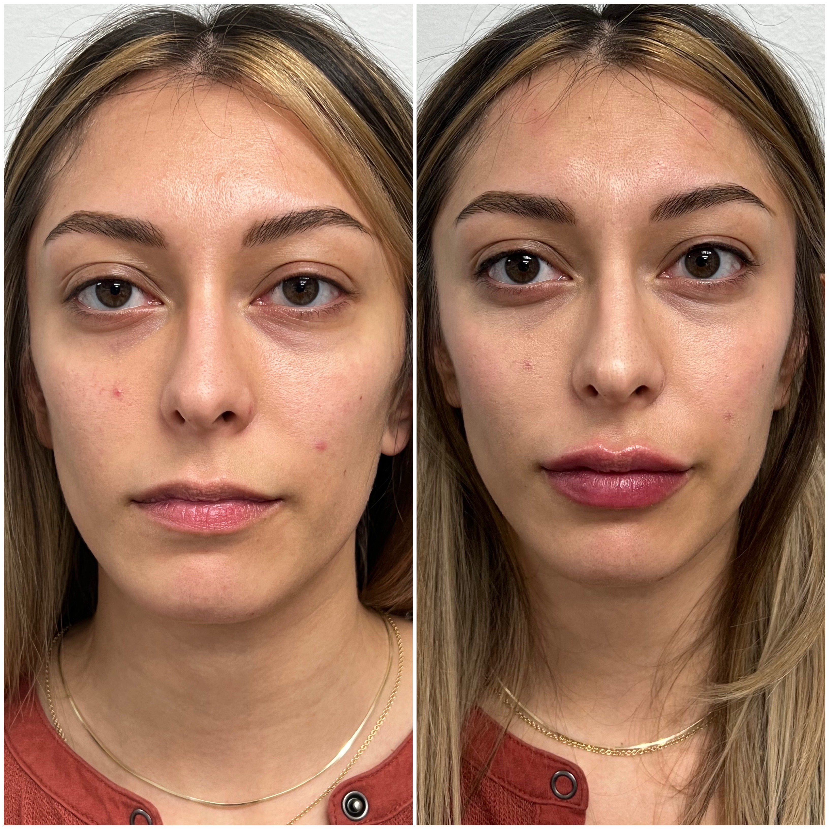 Lip treatment results